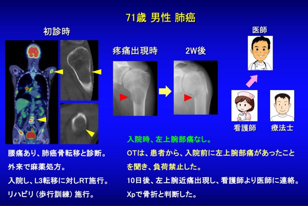 骨折・麻痺リスク評価