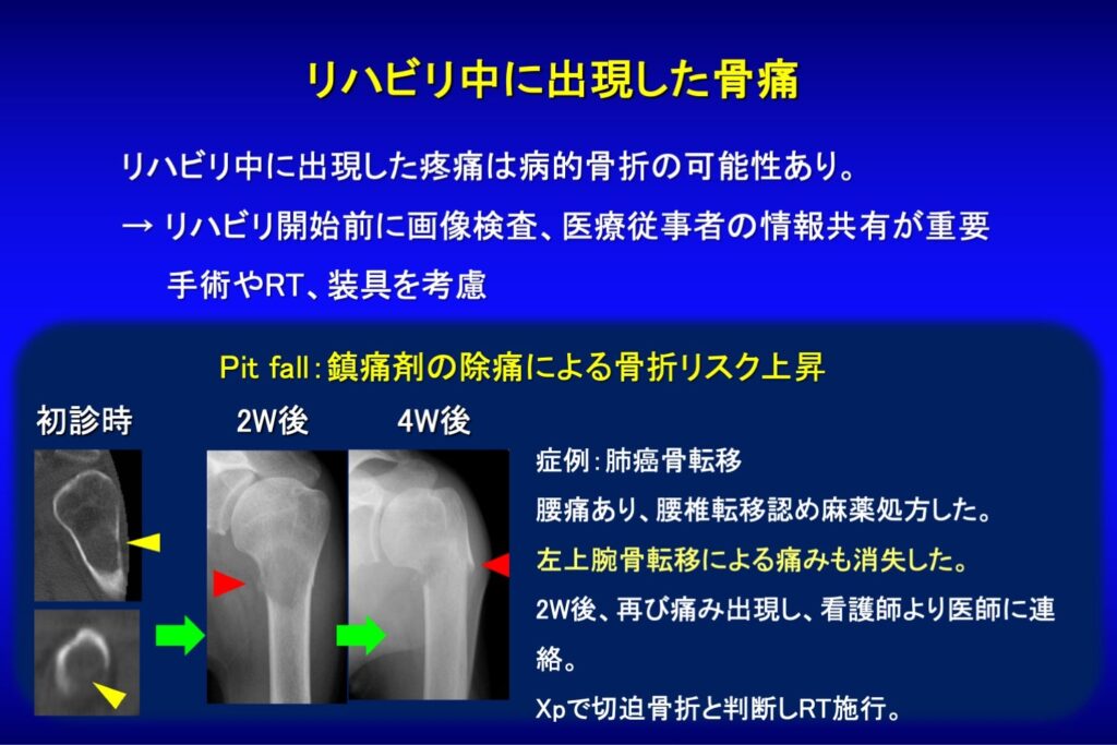 骨折・麻痺リスク評価