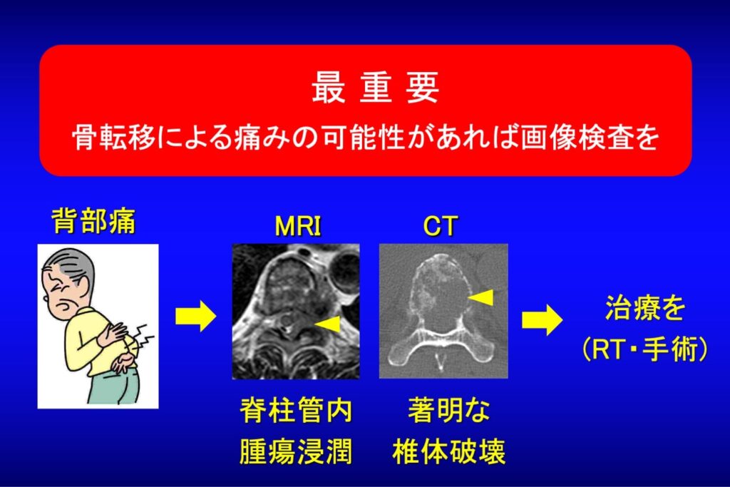 リハビリ中を含め、日常の診療で脊椎転移による背部痛をみのがさないために