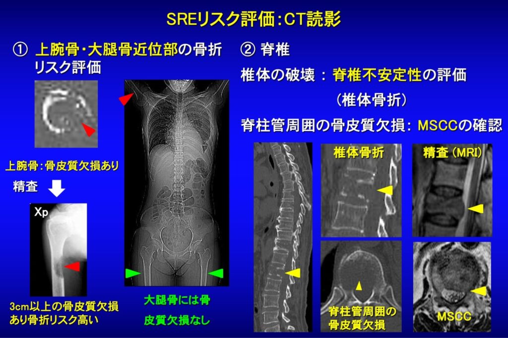 骨折・麻痺リスク評価